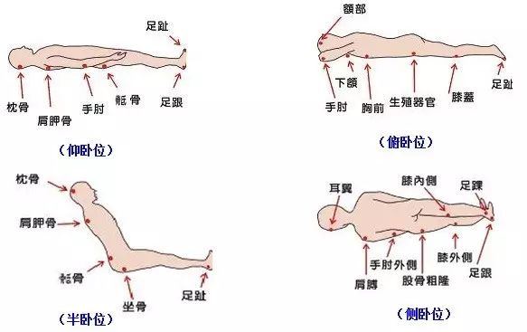 最新压疮的一期图片及其相关探讨